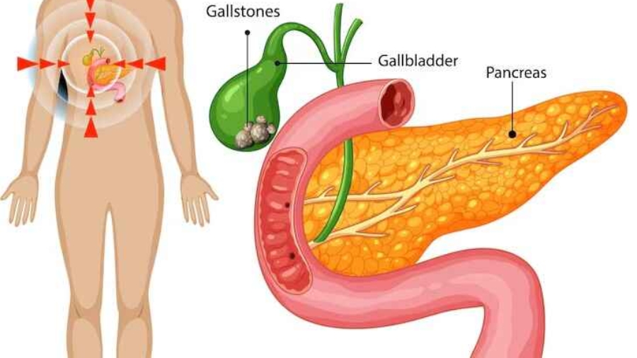 Gallstones