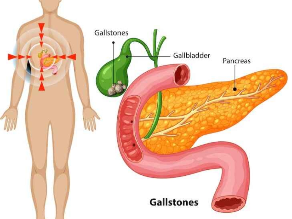 Gallstones